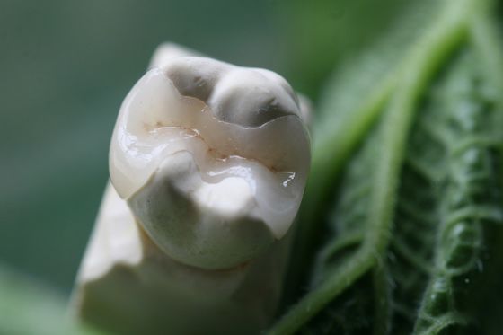 Naturel le regard de toute la porcelaine plaque la couronne dentaire d'EMAX