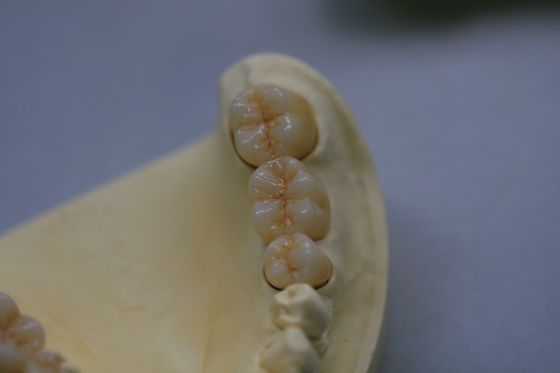 Couronne dentaire de laboratoire de zirconium d'oxyde de zircone dentaire de porcelaine avec en céramique