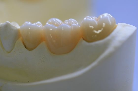 Le laboratoire dentaire a fixé la prosthétique a posé la couronne dentaire de zircone pour Front Teeth