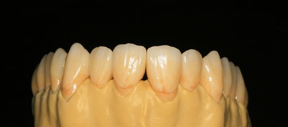 Le laboratoire dentaire a fixé la prosthétique a posé la couronne dentaire de zircone pour Front Teeth