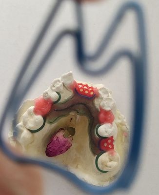 Cadre partiel en métal de dentier du Cr Co