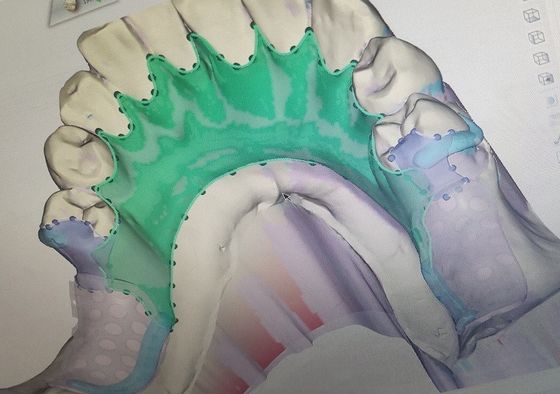3D démontable a imprimé le cadre partiel en métal de dentier