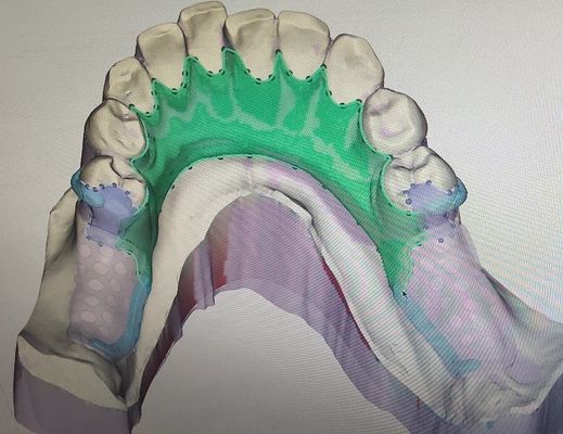 3D démontable a imprimé le cadre partiel en métal de dentier