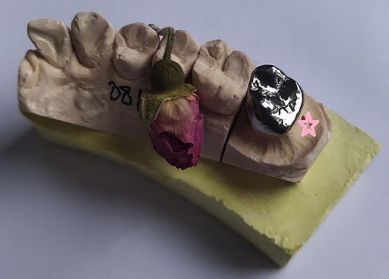 Le métal non précieux de pleine fonte allie la couronne dentaire