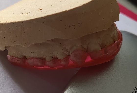 Garde maxillaire acrylique dure For Bruxism de stabilisation de voûte