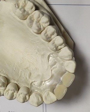 Dentier invisible mou confortable de l'ajustement ISO13485 RPD