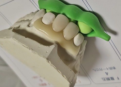 Dentier invisible libre en métal de résine pour le patient allergique