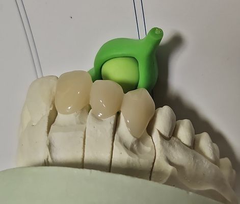 Le métal a basé la couronne provisoire hybride composée de PMMA