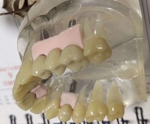 100 couronne provisoire de Biocompatibility PMMA de pour cent
