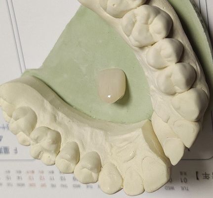 Couronne provisoire composée de couleur naturelle de résine pour les dents antérieures