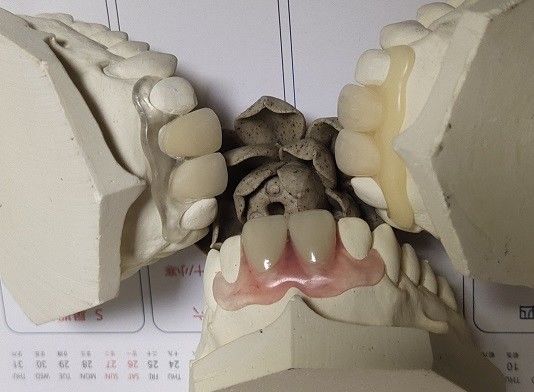 Dentier invisible flexible partiel pour les dents antérieures