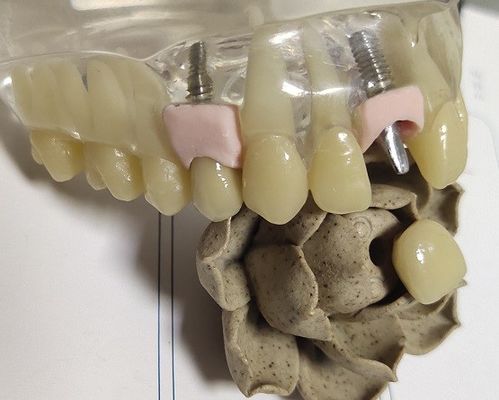 Blanc en métal fraisant la copie 3D dentaire de couronne intérieure de PFM