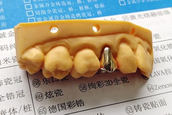 Couronne dentaire haut en métal noble d'or plein