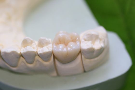 Couronnes postérieures en céramique en verre d'Aesthethics EMAX pour des molaires