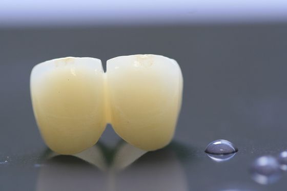 couronne dentaire de laboratoire du cadre PFM de l'impression 3D pour l'art dentaire