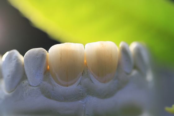 couronne dentaire de laboratoire du cadre PFM de l'impression 3D pour l'art dentaire