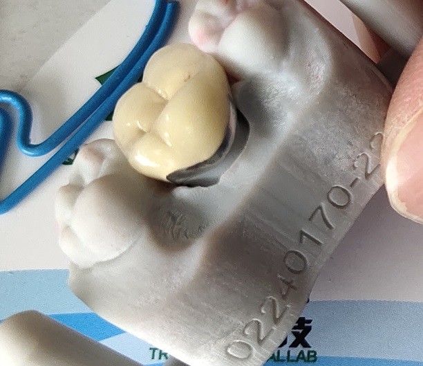 Porcelaine dentaire de couronne du DAO FAO PFM de produit de laboratoire fondue au métal