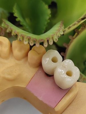 Les implants dentaires cimentés NOBEL BIOCARE de solution couronnent