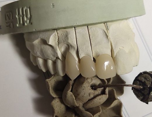 Couronne intérimaire de la technique ISO13485 de DAO