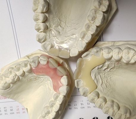 Dentier invisible libre en métal de résine pour le patient allergique
